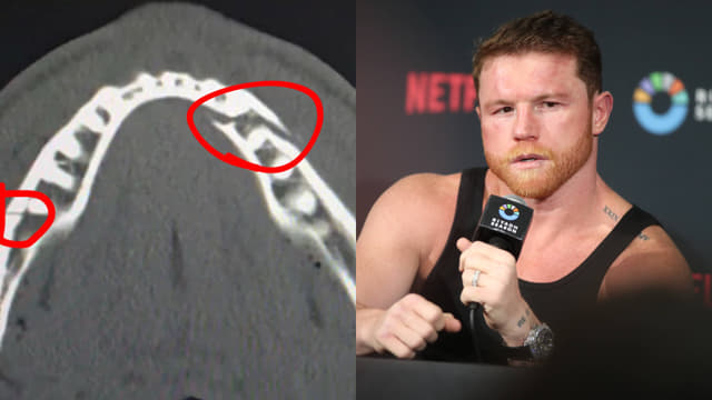 Jake Paul Confirms Broken Jaw After Anthony Joshua Loss, Calls Out Canelo Álvarez