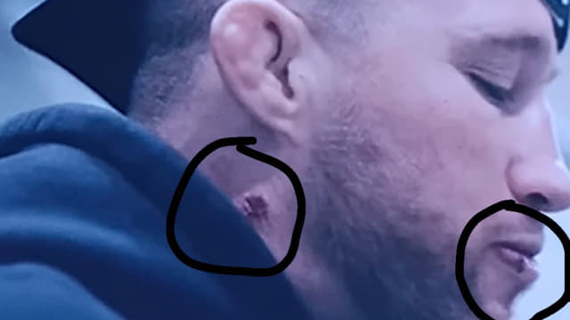 Justin Gaethje’s Neck Mark Sparks Concern Ahead of UFC 324