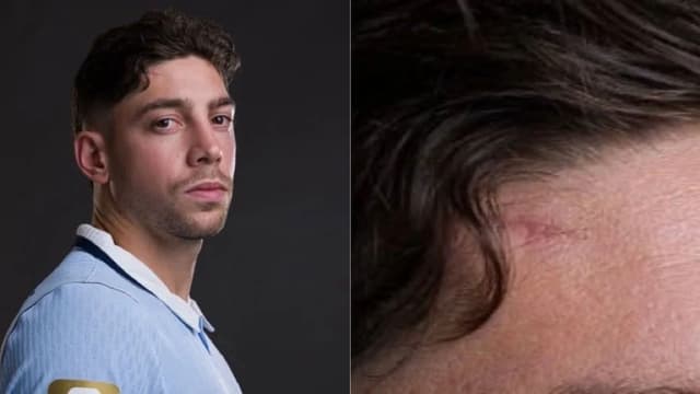 Federico Valverde’s World Cup Photo Shows Scar From Aurelien Tchouameni Fight